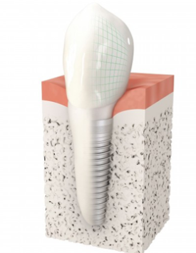 Implant dentaire Versailles